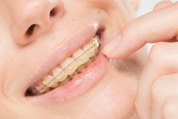 How To Keep Clear Braces From Yellowing