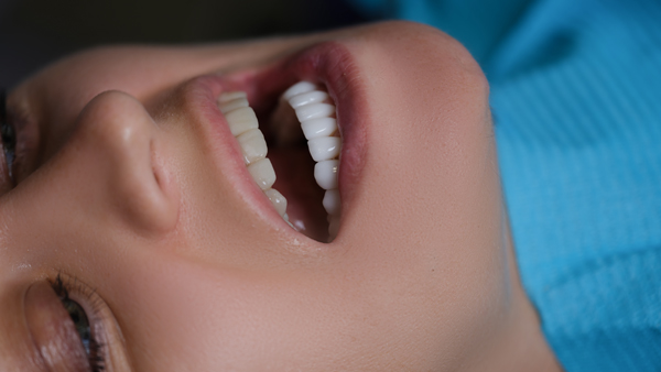 Fix A Chipped Tooth With A Dental Veneer