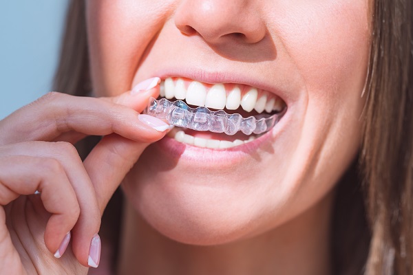 Invisalign Treatment from a General Dentist for Alignment or Crowding  Issues - Media Center Dental Burbank California
